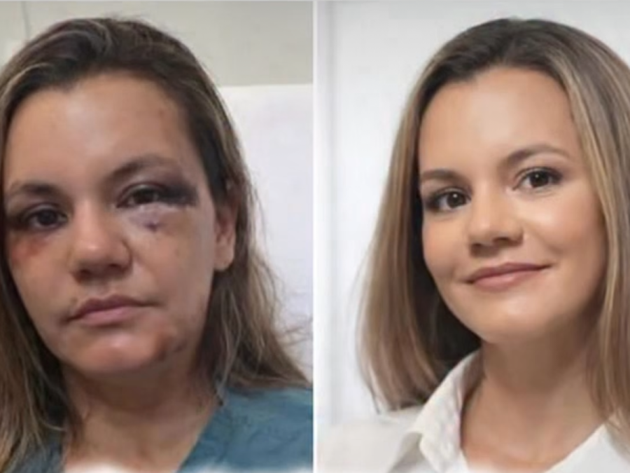 Mulher agredida com 61 socos pelo ex mostra reconstrução facial
