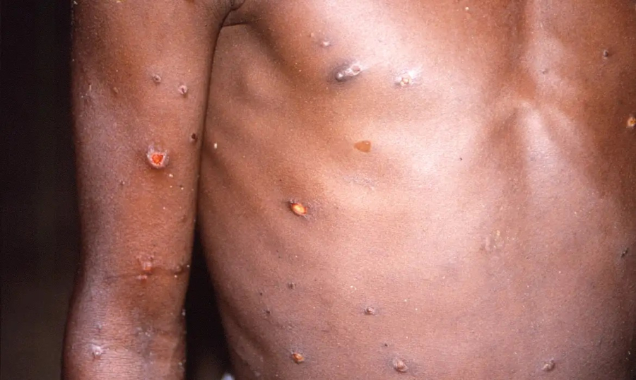 Brasil registra 48 casos de mpox nos primeiros meses de 2026