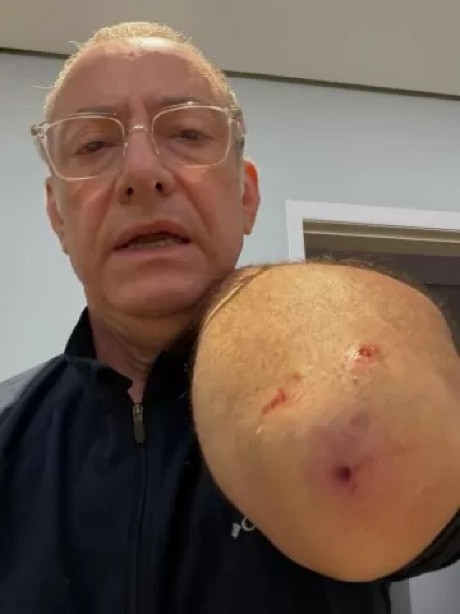 Jornalista da Globo é atacado por pitbull sem guia